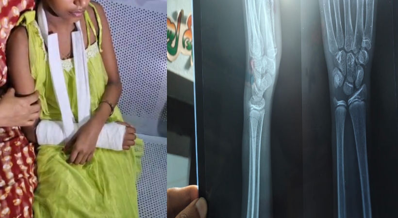 ക്ലാസിൽ ശ്രദ്ധിച്ചില്ല; അഞ്ചാം ക്ലാസുകാരിയെ ചൂരൽ കൊണ്ട് അടിച്ച് അധ്യാപകൻ, കൈ എല്ല് പൊട്ടി
